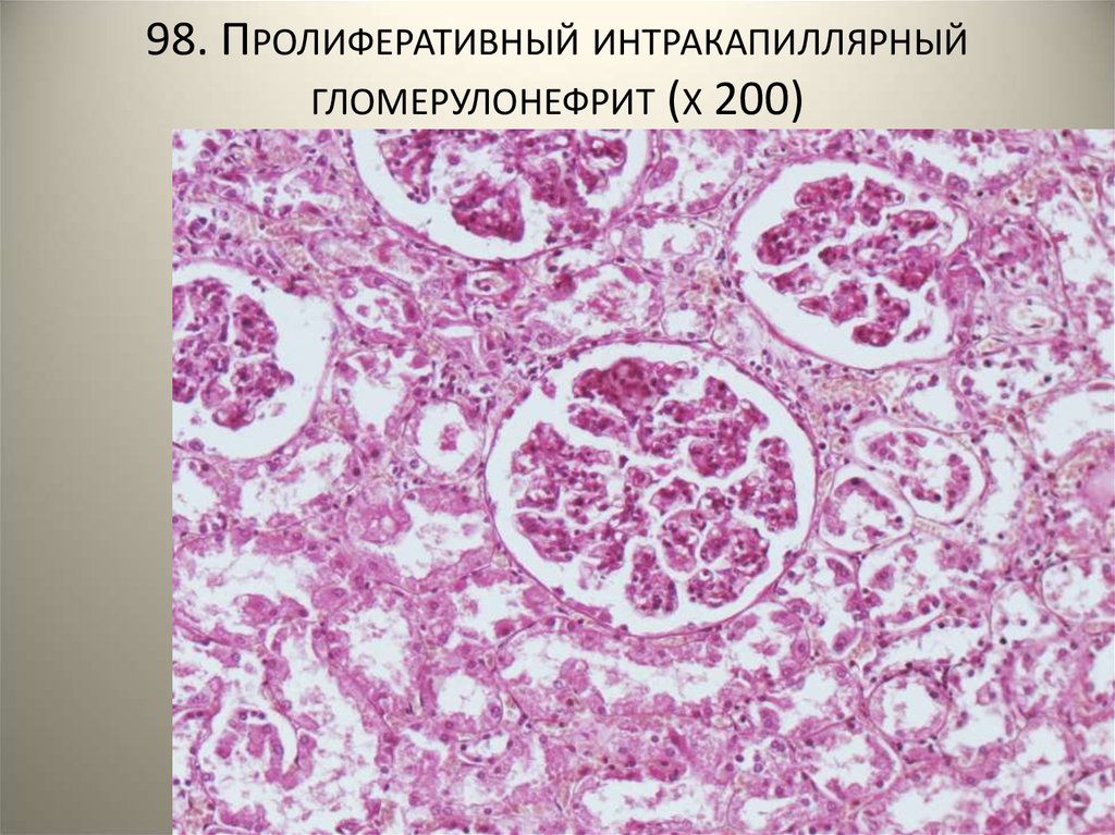 Пролиферативный. Интракапиллярный продуктивный гломерулонефрит. Интракапиллярный пролиферативный гломерулонефрит макропрепарат. Острый пролиферативный интракапиллярный гломерулонефрит. Острый интракапиллярный гломерулонефрит микропрепарат.