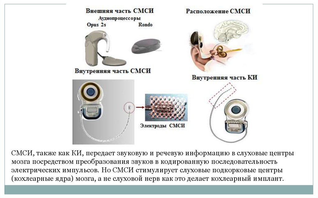 Схема работы кохлеарного импланта