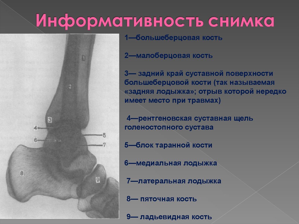 Голеностопный сустав норма. Голеностопный сустав сбоку рентген. Кости голеностопного сустава анатомия. Перелом таранной кости стопы рентген. Голеностопный сустав рентген анатомия рентгеноанатомия.