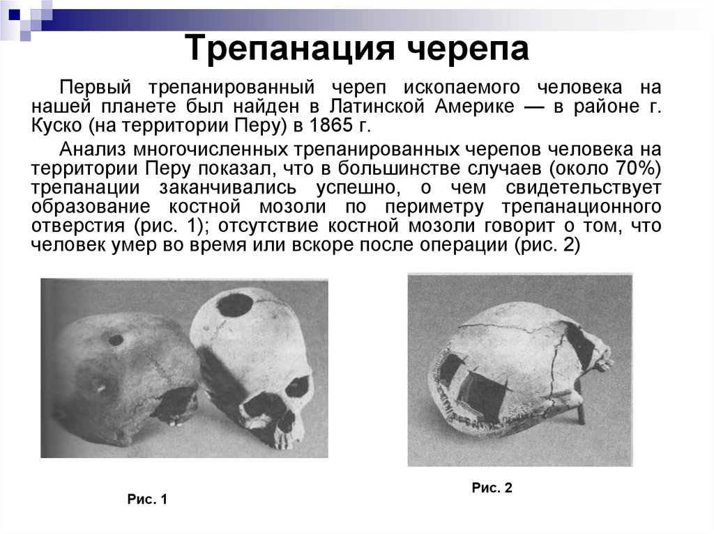 Трепанация черепа презентация