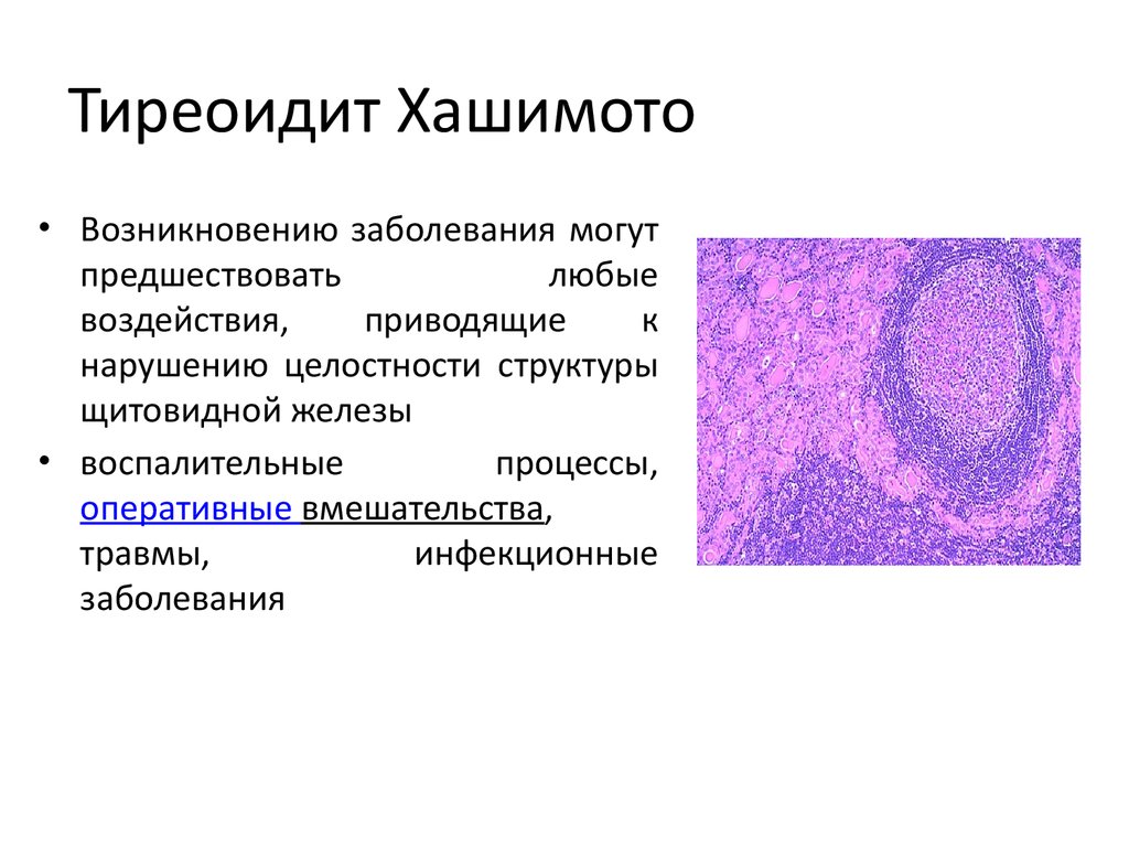 Первичный гипотиреоз на фоне аутоиммунного тиреоидита