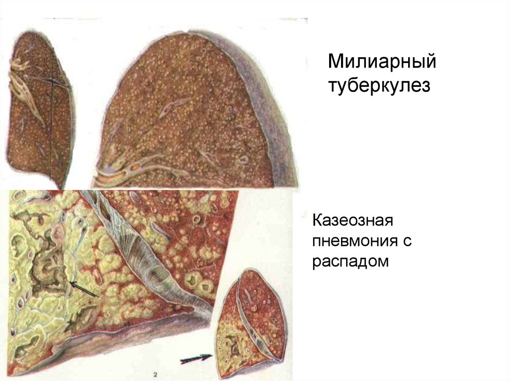 Поражение тканей легких. Казеозная пневмония туберкулез. Милиарный туберкулёз и казеозная пневмония. Казеозная пневмония макропрепарат. Ацинозная казеозная пневмония.