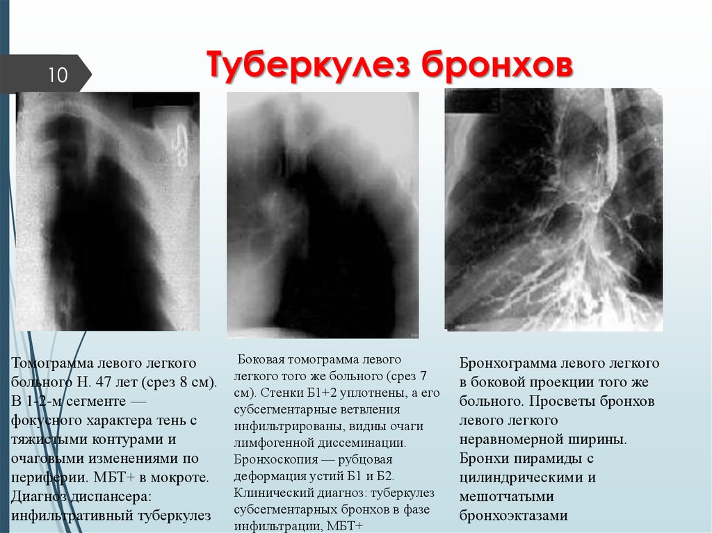 Как проверить легкие и бронхи кроме флюорографии. Инфильтративный туберкулез бронхов. Бронхогенный туберкулез кт. Клинико-рентгенологические проявления туберкулеза бронхов. Туберкулез бронхов трахеи и верхних дыхательных путей рентген.