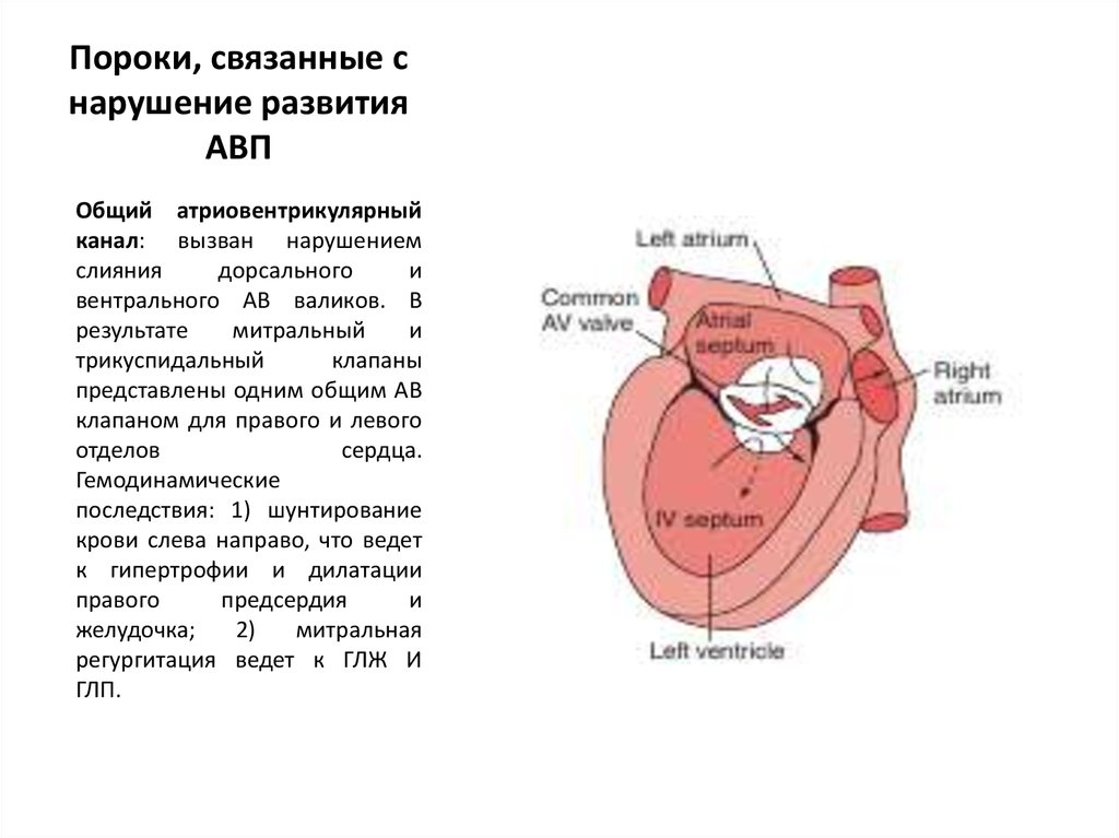 Дилатация левого предсердия степени