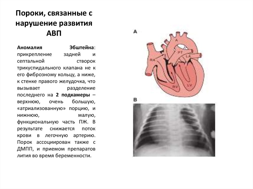 При аномалии эбштейна легочный рисунок