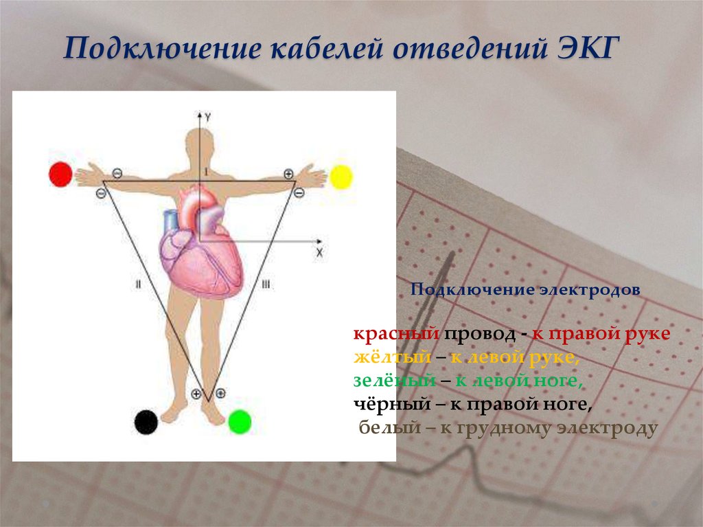 Стандартные отведения экг схема наложения электродов