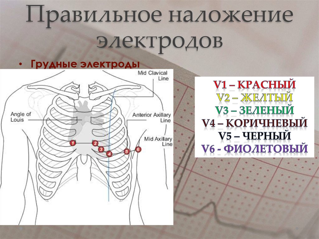 Правильное наложение электродов монитора