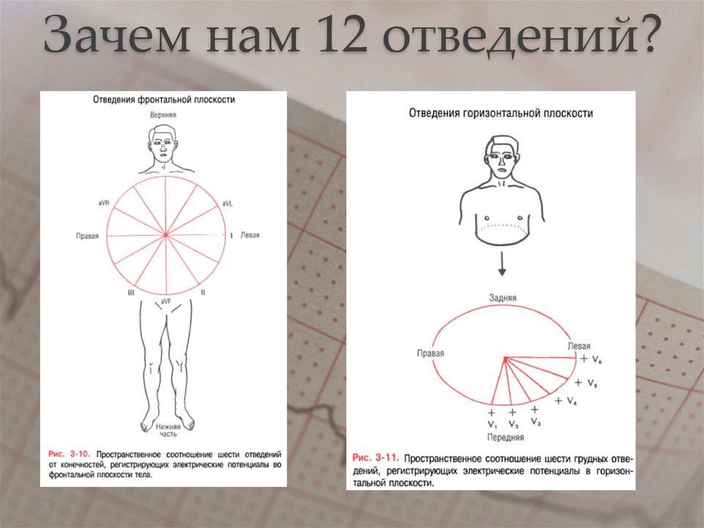 12 отведений экг схема