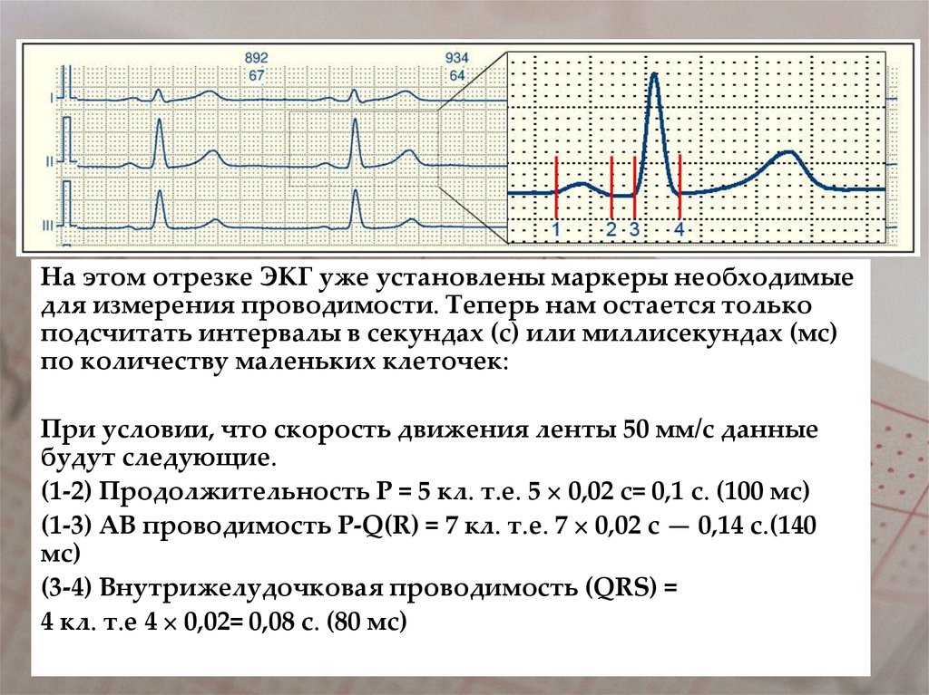 Как измерить частоту сердечных. Подсчёт ЧСС по ЭКГ 50 мм. Как посчитать комплекс QRS на ЭКГ. Подсчёт ЧСС по ЭКГ 25 мм. Нормы PQ QRS qt.