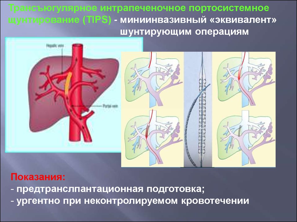 Портальная гипертензия хирургия презентация