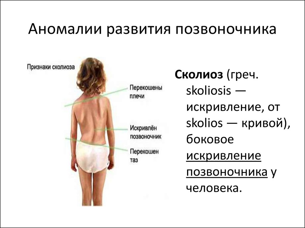 Симптомы сколиоза. Аномалии развития позвоночника сколиоз. Боковое искривление позвоночника человека. Основной симптом сколиоза. Проявление боковых искривлений позвоночника.