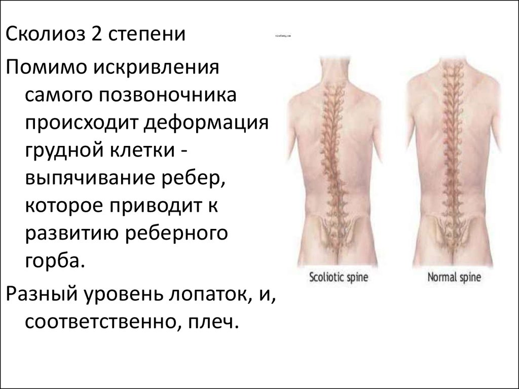 Стадии искривления