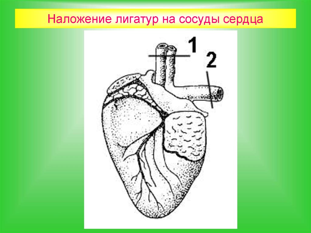 Книга сердце и сосуды. Наложение лигатуры на сосуд. Варианты наложения лигатуры на сосуды. Лигатуры сердца.