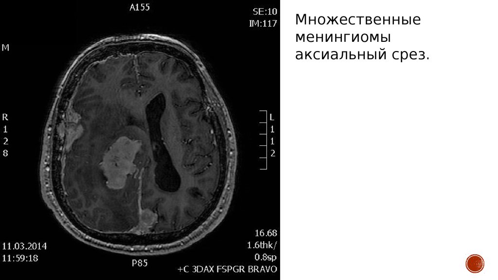 Менингиома головного мозга лечение