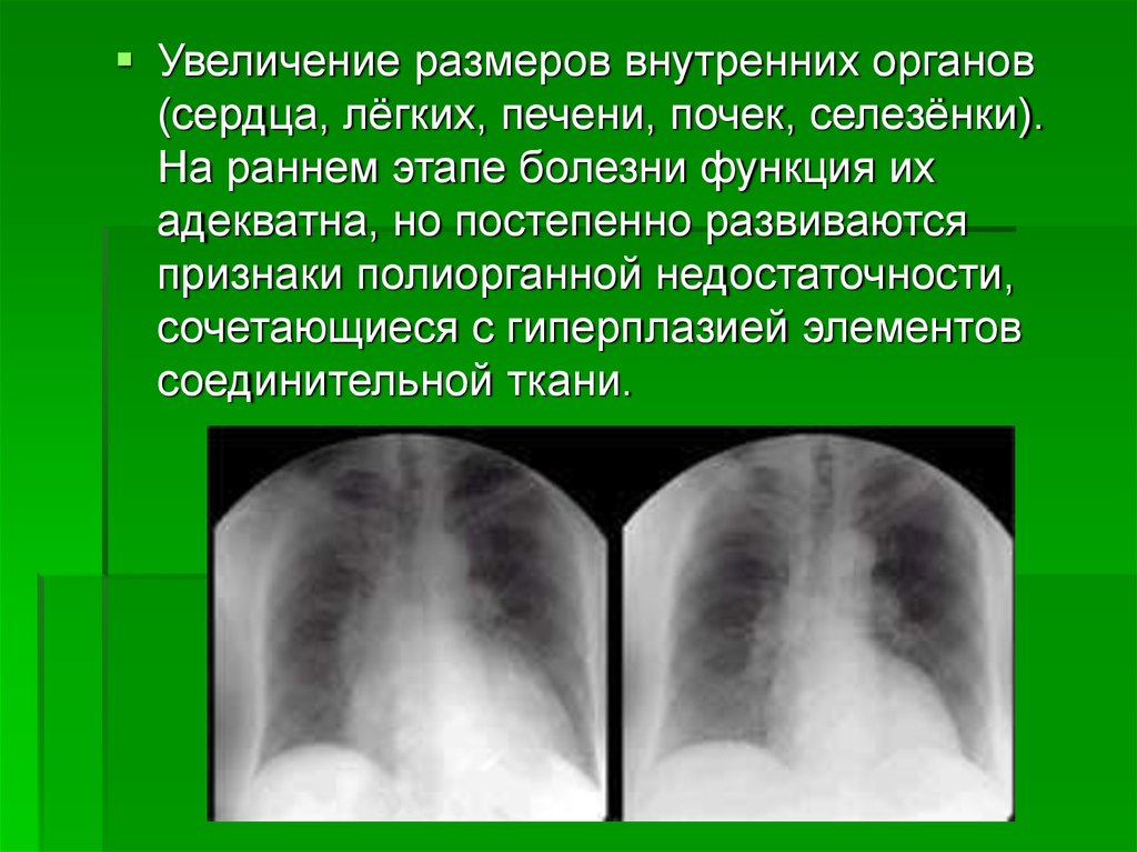 Усиление болезни. Акромегалия рентген признаки. Рентгенологические признаки при акромегалии. Косвенные рентген признаки акромегалии. Косвенными рентгенологическими признаками акромегалии являются:.