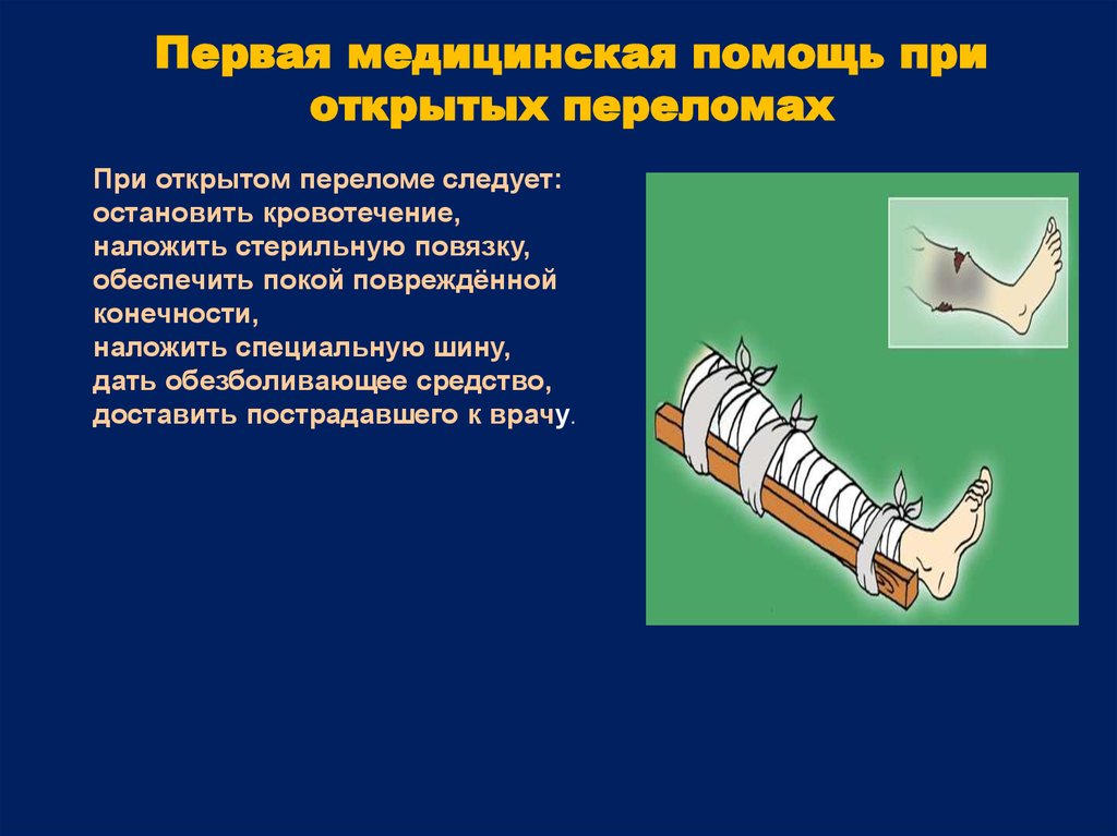 Кровотечение при открытом переломе голени