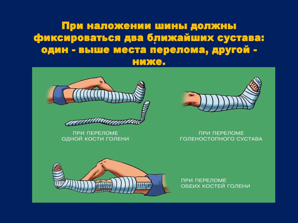 При открытом переломе накладывают. Шина Крамера перелом костей голени. Перелом голени наложение шины. Шина при переломе костей голени. Наложение транспортной шины при переломе костей голени.