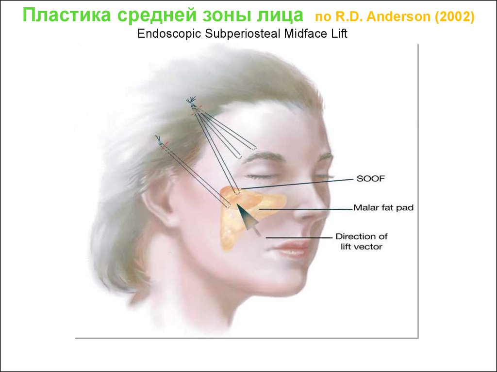В зона на лице где. Ереломы средней зоны лица». Средняя зона лица границы. Орбитальная зона лица. Отеки после пластики средней зоны лица.