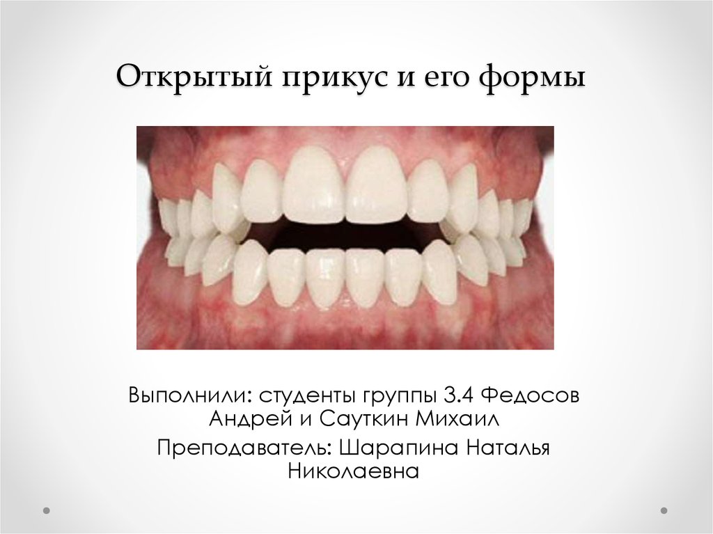 Открытый прикус. Открытый прикус степени тяжести. Открытый скелетный прикус. Рахитический открытый прикус. Открытый передний прикус схема.