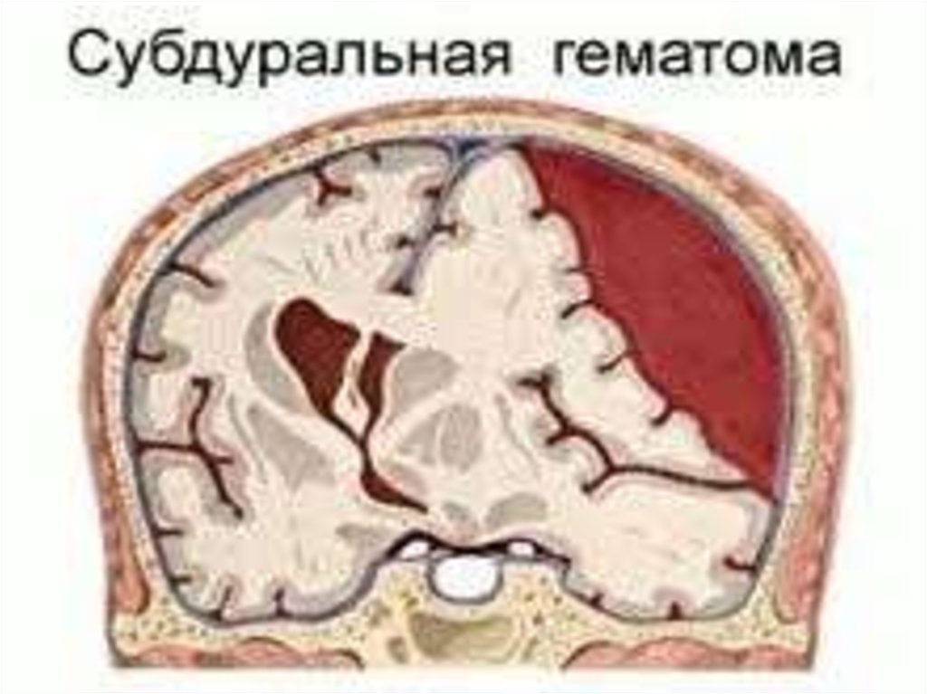 Травматическое кровоизлияние. Внутричерепная субдуральная гематома. Сдавление головного мозга гематомой. Плащевидная субдуральная гематома. Субдуральное кровоизлияние головного мозга.