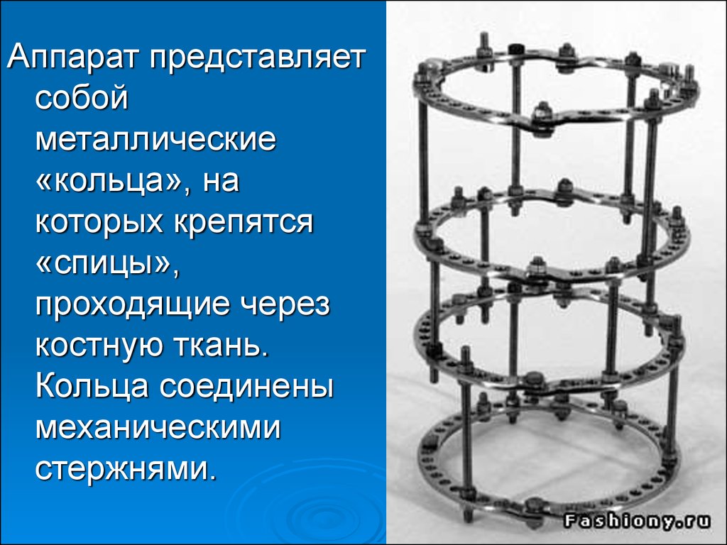 Аппарат илизарова картинки