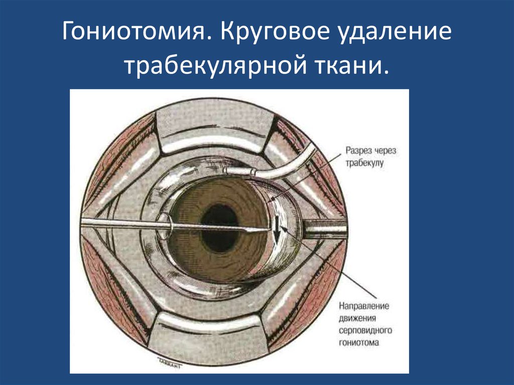 Врожденная глаукома презентация