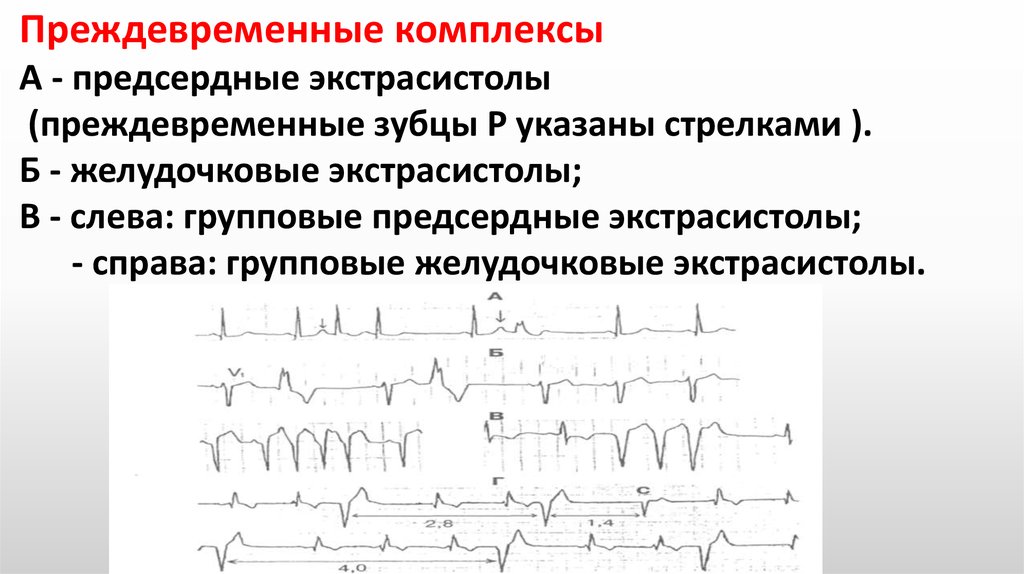 Желудочковая эктопическая активность в виде одиночных экстрасистол. Блокированная желудочковая экстрасистолия. Аберрантные предсердные экстрасистолы на ЭКГ. Аберрантные экстрасистолы на ЭКГ. Желудочковая экстрасистолия зубцы.