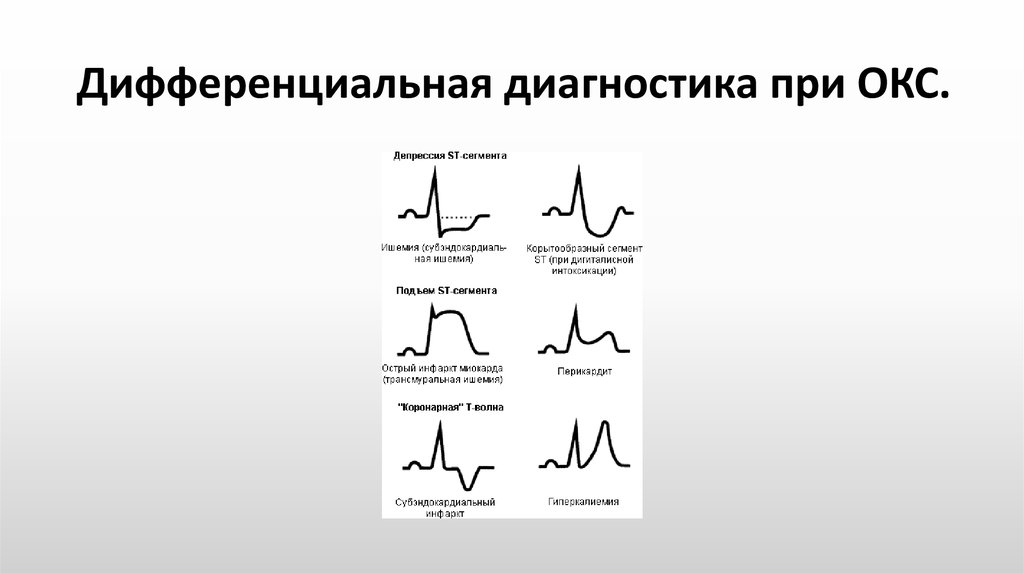 Экг синдромы при окс