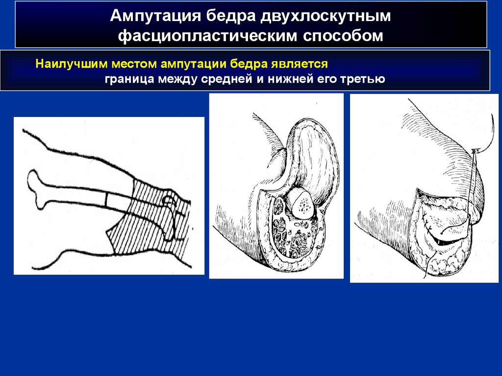 Периоды ампутации. Двухлоскутная ампутация бедра. Ампутация бедра по Гритти-Шимановскому. Ампутация бедра двухлоскутным фасциопластическим способом. Ампутация по среднюю треть бедра.