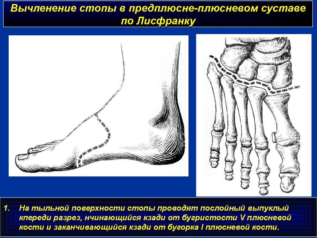 Ампутация по шопару схема