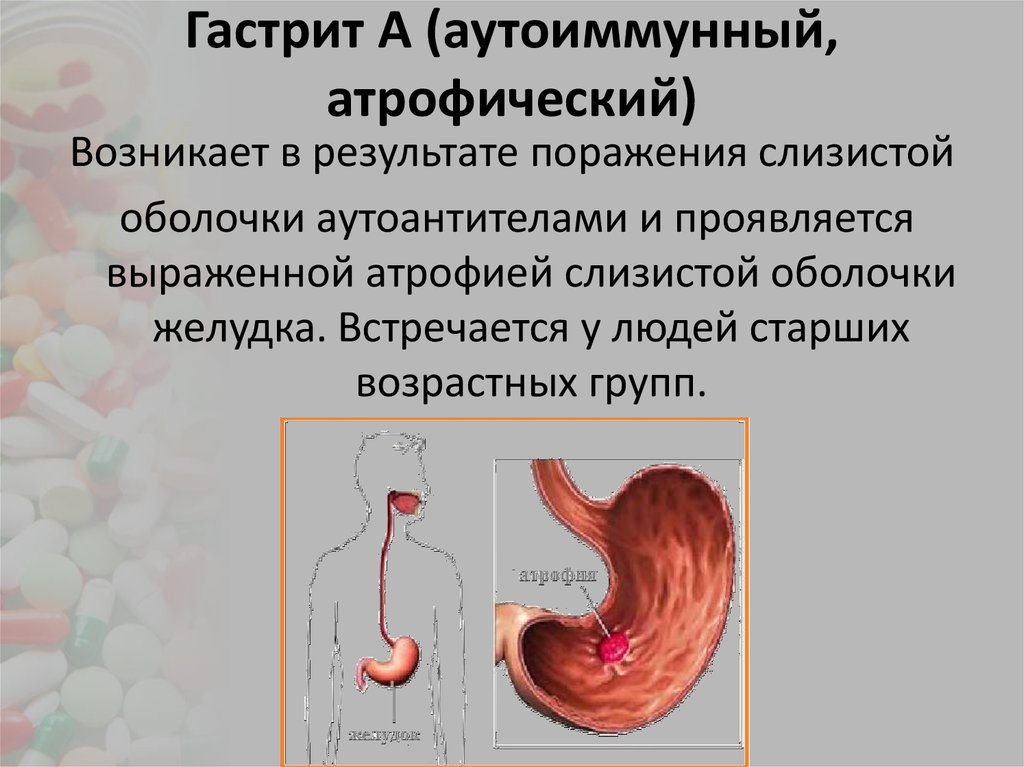 Презентация на тему гастрит