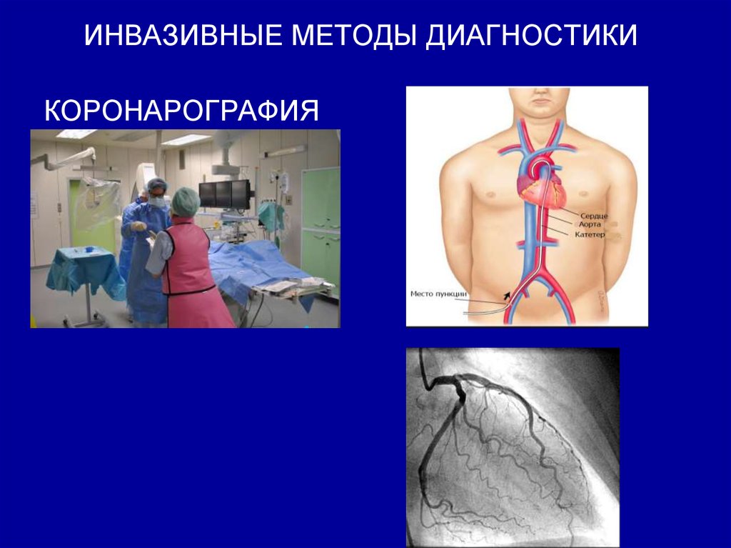 Коронарография. Коронарография методика. Инвазивная коронарография. Коронарография инвазивный метод.