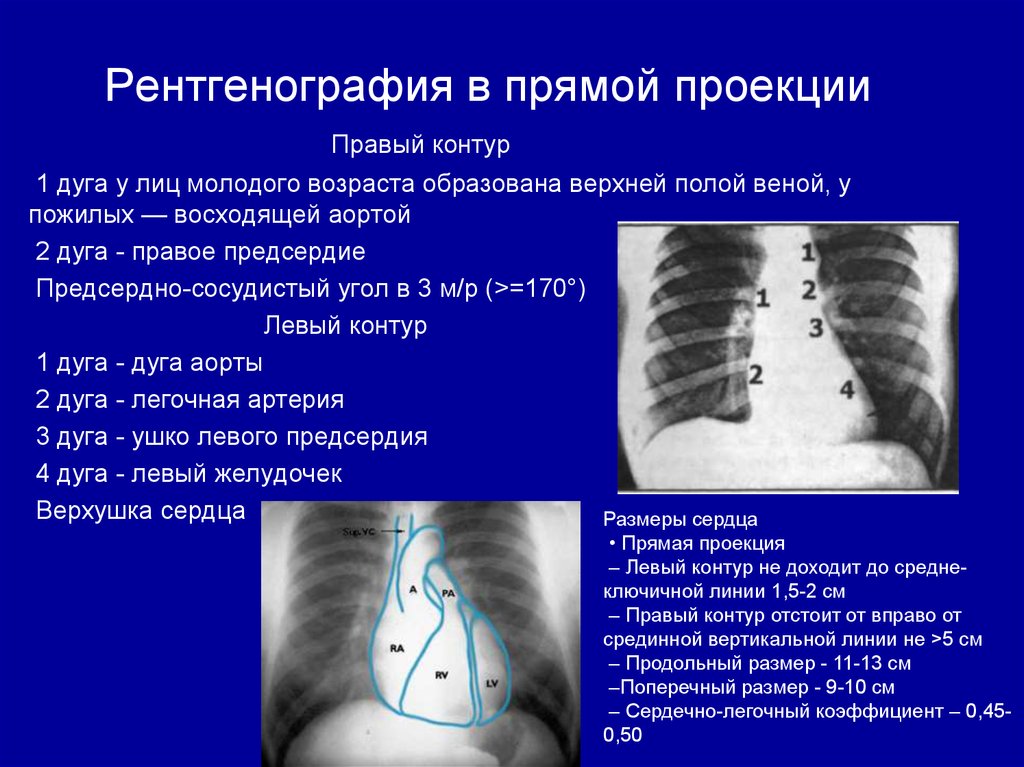 Рентгенография в двух проекциях. Рентген сердца в прямой проекции норма. Сердечно-легочный коэффициент. Рентгенография в прямой проекции. Рентгенография сердца в прямой проекции.