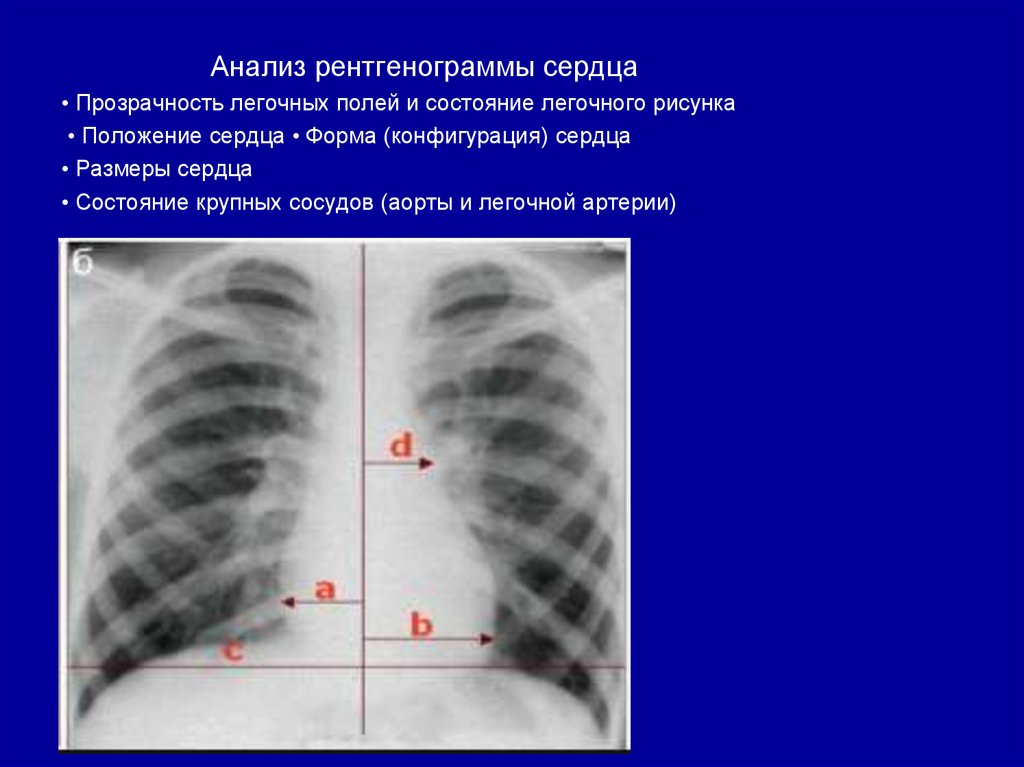 Что значит легкие расширены. Легочное сердце на рентгенограмме. Форма легочных полей. Патология сердца на рентгенограмме.