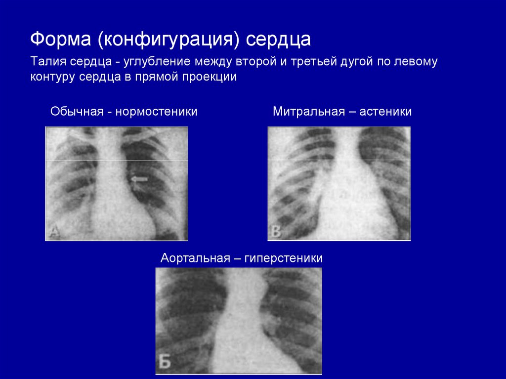 Талия сердца