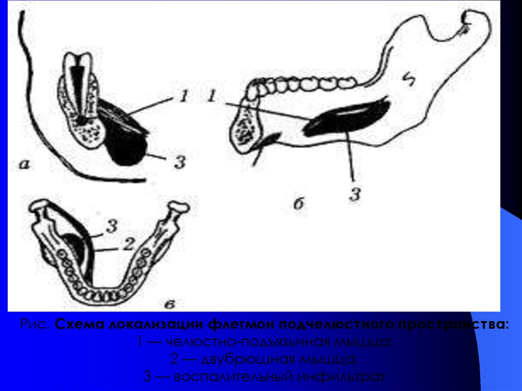 Поднижнечелюстная флегмона. Флегмона нижней челюсти. Абсцессы и флегмоны нижней челюсти схема. Подчелюстное пространство. Пространства нижней челюсти.