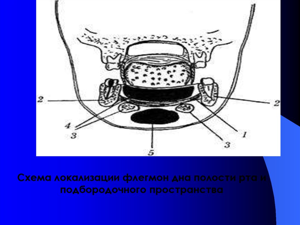 Дне схема. Схема клетчаточных пространств дна полости рта. Вскрытие флегмоны дна полости рта. Методики вскрытия флегмон дна полости рта.