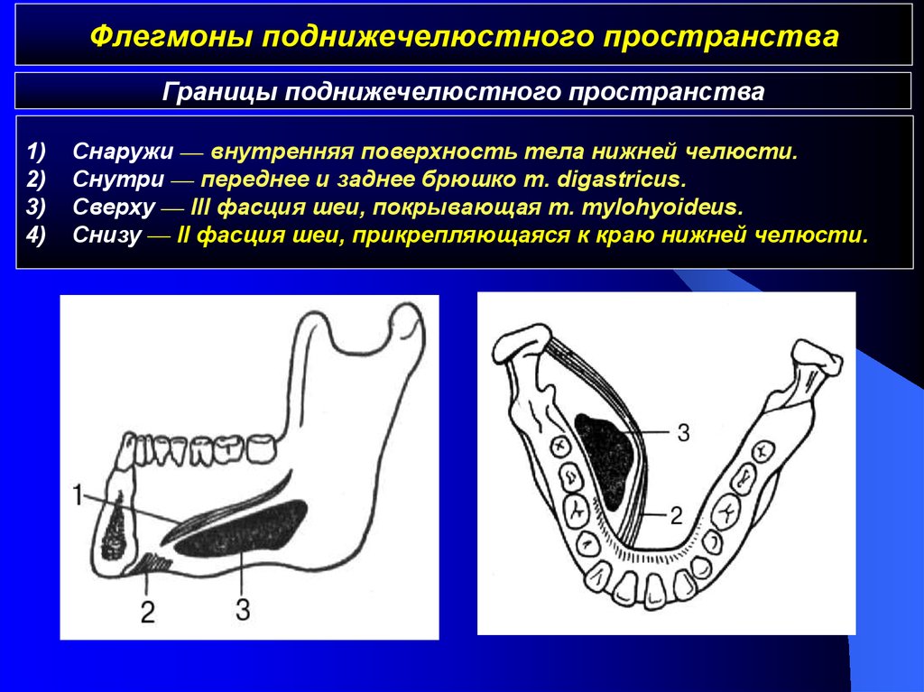 Окологлоточные флегмоны