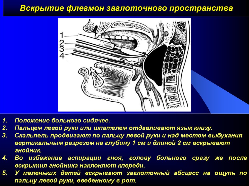 Вскрытие флегмон и абсцессов. Ретрофарингеальный абсцесс вскрытие. Флегмона окологлоточного пространства. Вскрытие заглоточного абсцесса.