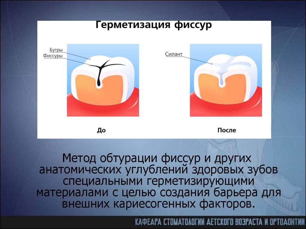 После метода. Методика инвазивной герметизации фиссур. Профилактика фиссурного кариеса герметизация фиссур. Профилактика кариеса герметизацией фиссур. Фиссура зуба герметизация.