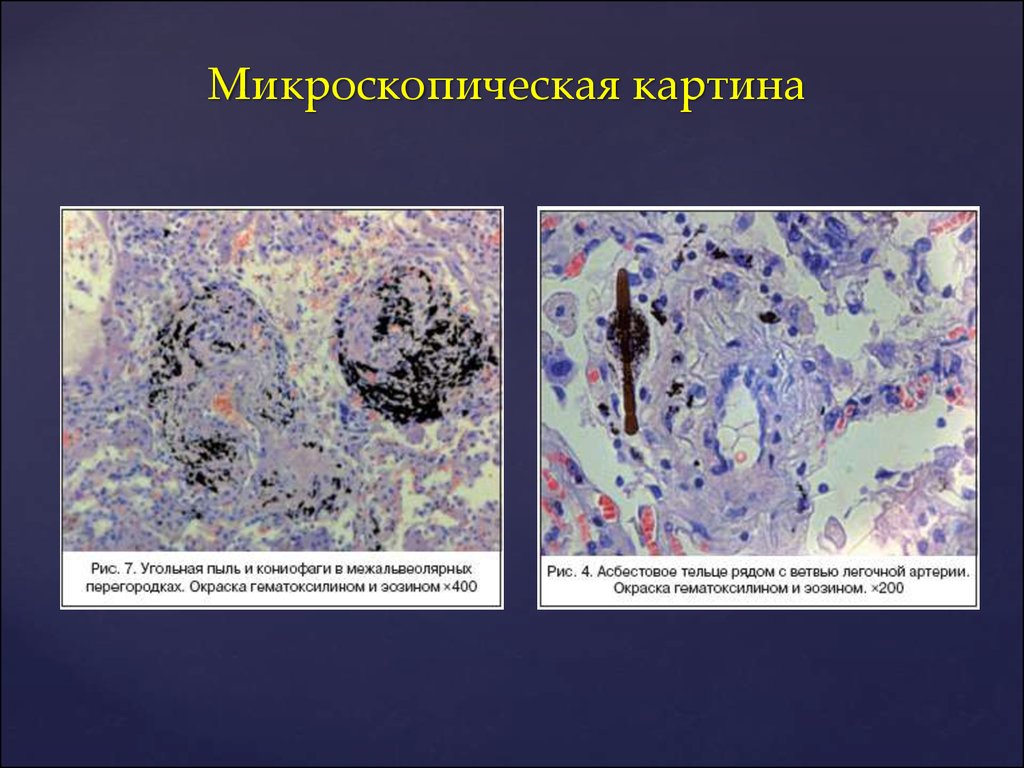 Микроскопическая картина. Микроскопическая картина u-. Микроскопическая картина туберкулеза. Пылевые клетки в мокроте.