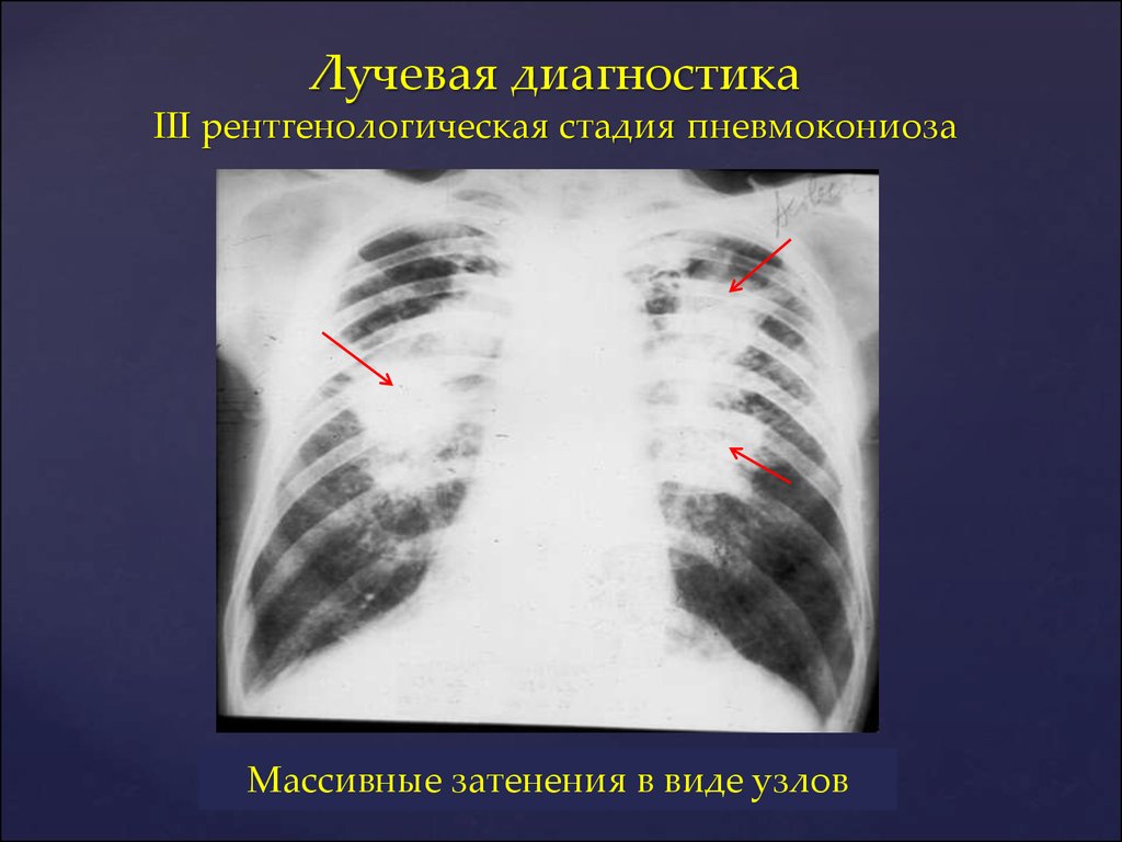 Пневмокониоз легких. Пневмокониоз 3 стадии рентген. Пневмокониоз легких 3 стадии рентген. Пневмокониоз рентген картина. Пневмокониоз легких 1 стадия рентген.