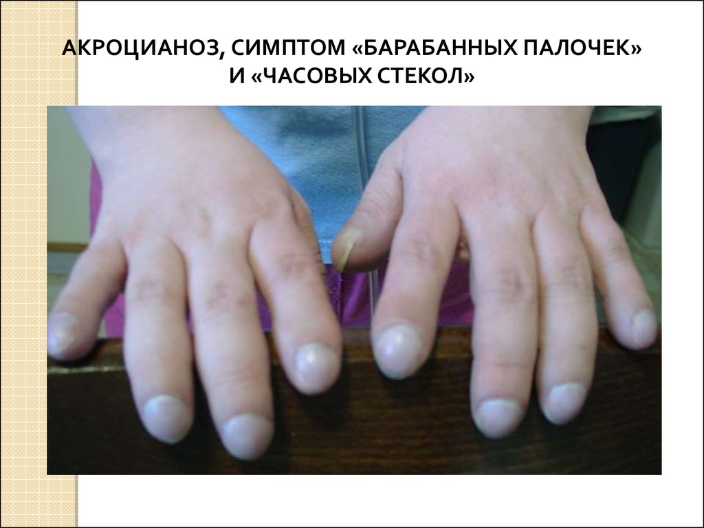 Пальцы стали толще. Остеоартропатия Мари-Бамбергера. Барабанные палочки ногти Гиппократа. Болезнь Мари Бамбергера. Ногти Гиппократа барабанные пальцы.