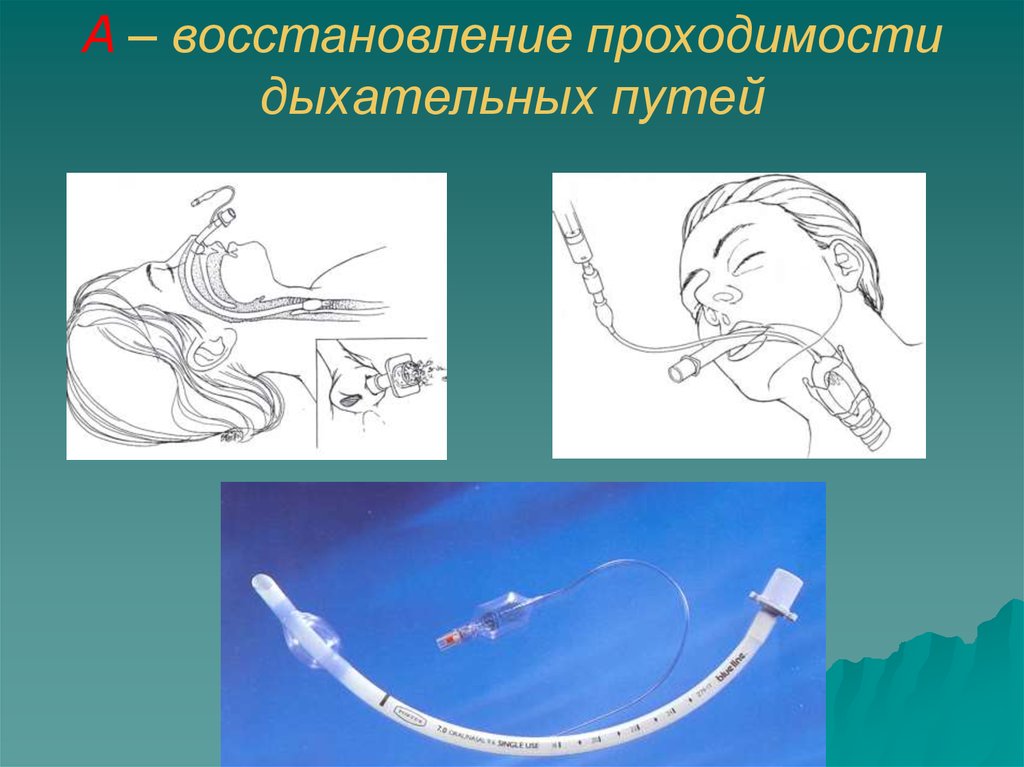 Восстановление проходимости. 2. Методы восстановления проходимости верхних дыхательных путей тест. Методика восстановления проходимости верхних дыхательных путей рис 1.