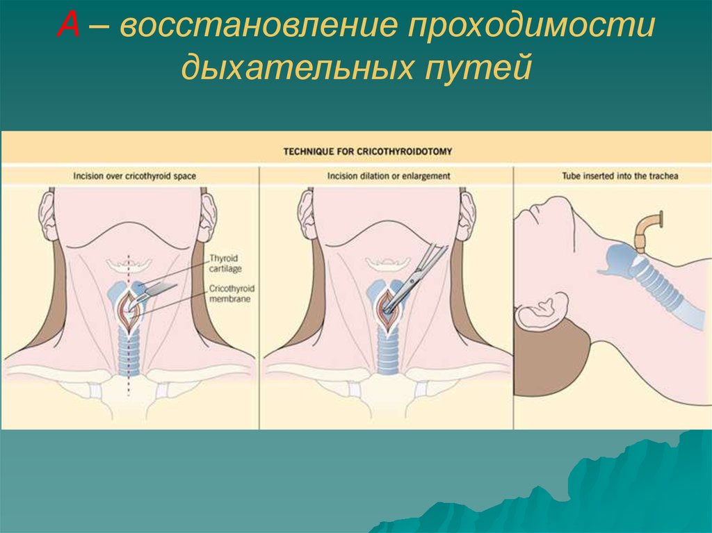 Проходимость дыхательных путей. Восстановление проходимости дыхательных путей. Восстановление проходимости дыхательных путей фото. Кт на проходимость дыхательных путей. Восстановление проходимости путей новорожденного.