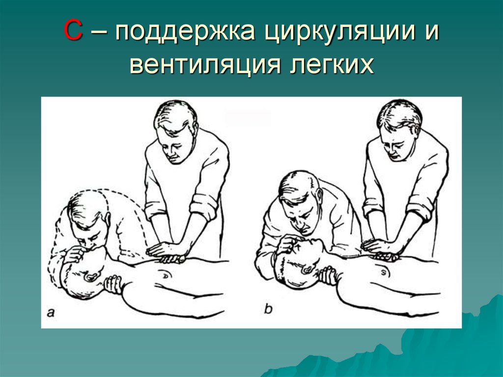 Ивл частота вдуваний в минуту. Сердечно легочная реанимация 2 человека. Проведение СЛР двумя спасателями.