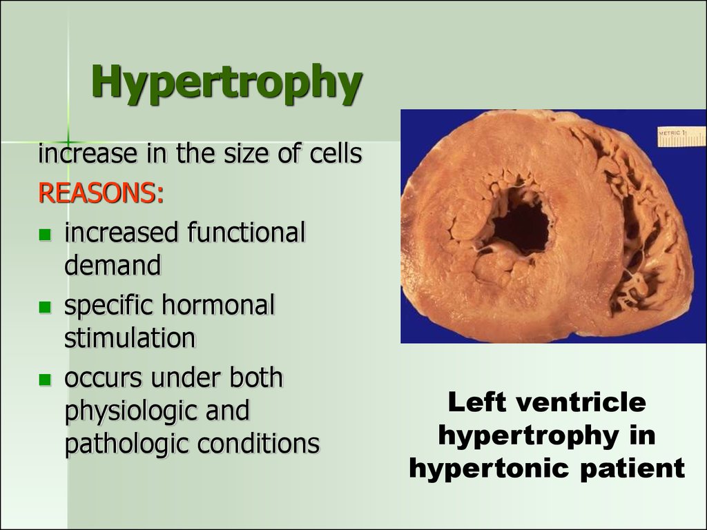 pathological hypertrophy examples