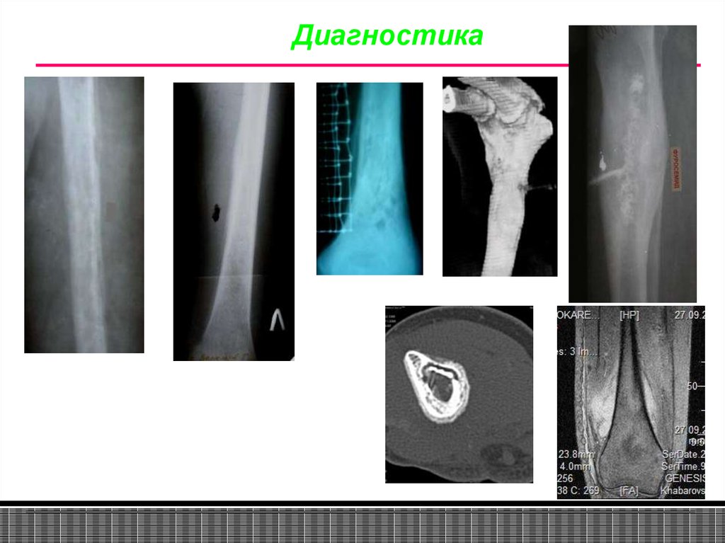 Острый остеомиелит диагностика