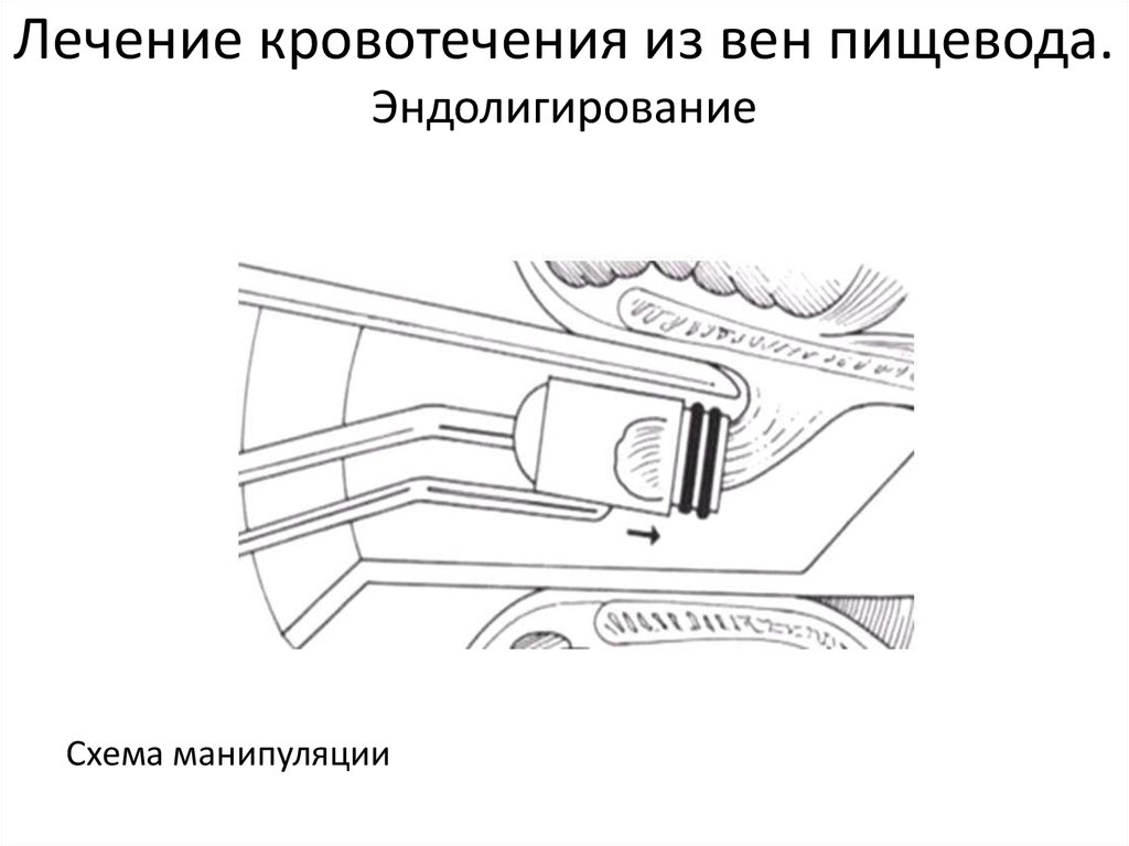 Кровотечение из расширенных вен пищевода карта вызова смп