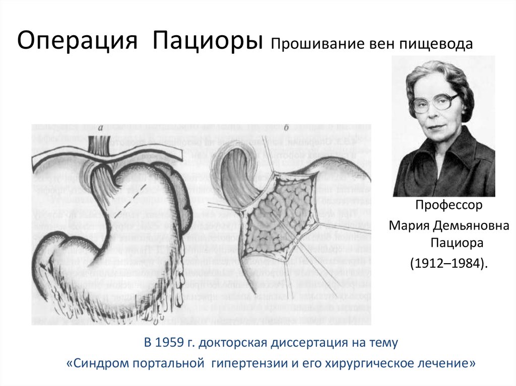 Операция м. Операция Таннера Пациоры. Прошивание вен пищевода по Пациора.